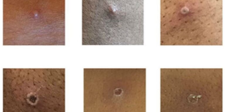 Hautläsionen bei Patienten, bei denen Affenpocken nachgewiesen wurden.