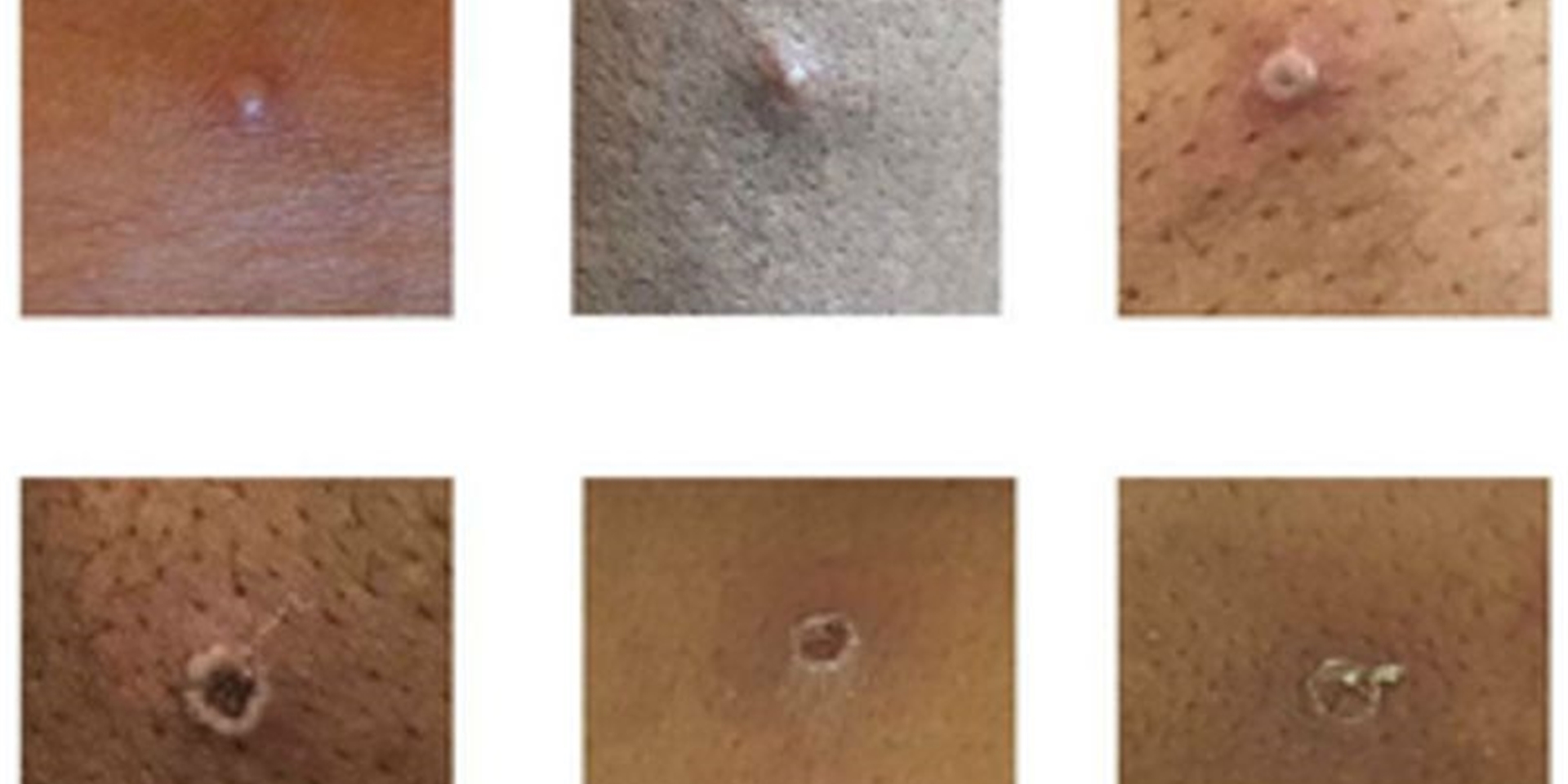 Hautläsionen bei Patienten, bei denen Affenpocken nachgewiesen wurden.
