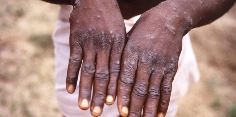 Dieses Bild aus dem Jahr 1997, das von der CDC während einer Untersuchung eines Affenpockenausbruchs in der Demokratischen Republik Kongo (DRC), dem früheren Zaire, zur Verfügung gestellt wurde, zeigt die Rückenflächen der Hände eines Affenpocken-Patienten, der den charakteristischen Ausschlag in der Erholungsphase zeigte.