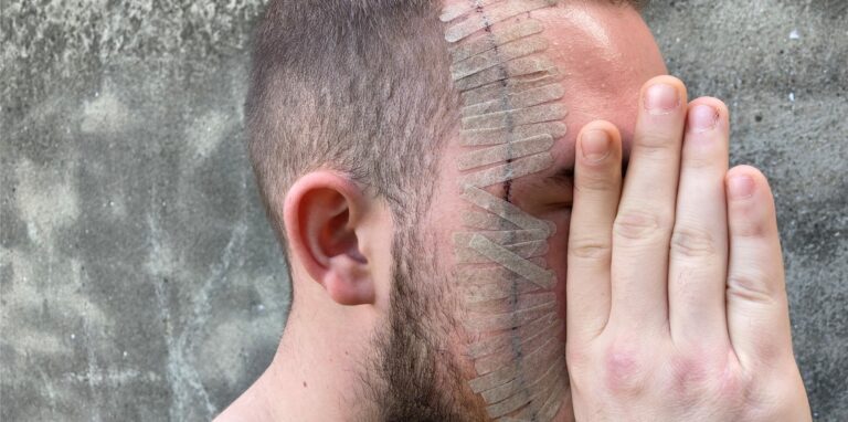 Ein Mann verdeckt sein Gesicht teilweise mit der Hand. Auf der einen Hälfte ist eine lange genähte und geklebte Schnittwunde zu sehen.