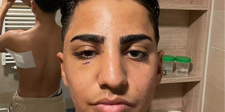 Der 19-jährige Ali A. ist durch einen Messerangriff, Schläge und Tritte verletzt worden. Seine Schilderung des Vorfalls in der Nacht auf den 1.10. erreicht im sozialen Netzwerk TikTok bis zu eine Million Menschen.