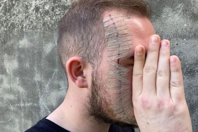In einer dreieinhalbstündigen Not-OP war das Gesicht des Recklinghäusers genäht und geklebt worden.