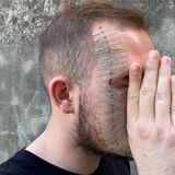 In einer dreieinhalbstündigen Not-OP war das Gesicht des Recklinghäusers genäht und geklebt worden.