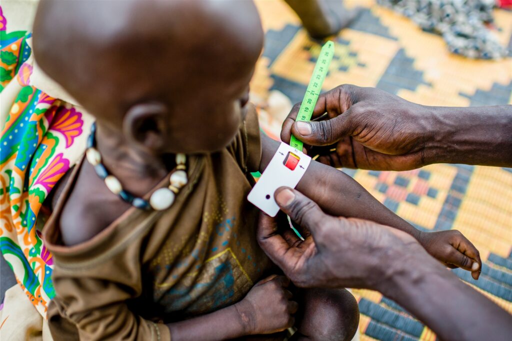 Ein unterernährtes Kind wird im Südsudan behandelt. Spulspeisung im Sudan ist eins der Projekte, in die die Spenden fließen sollen.